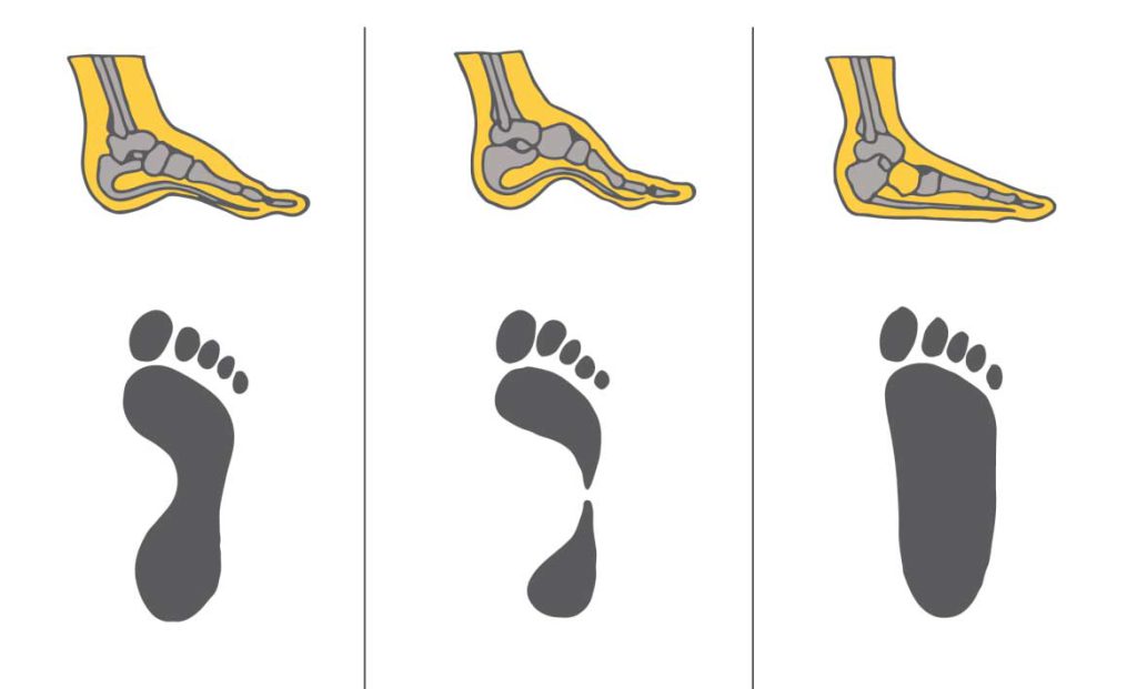 چگونه کفش مناسب برای فرم پای خود انتخاب کنیم؟